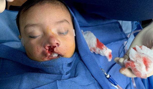Why Cleft Lip and Palate Surgeries Are So Important