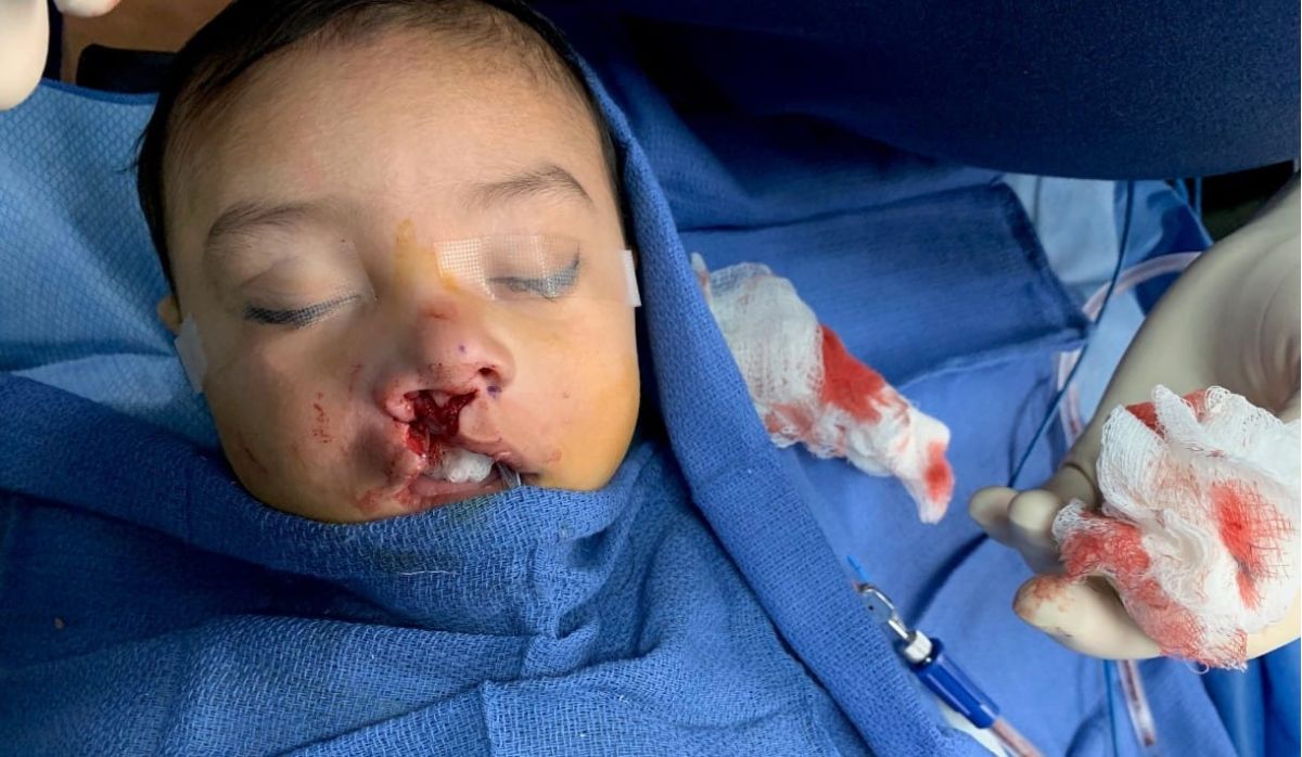 Why Cleft Lip and Palate Surgeries Are So Important